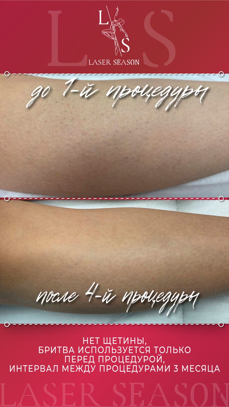 Результат лазерной эпиляции до и после, пример 1